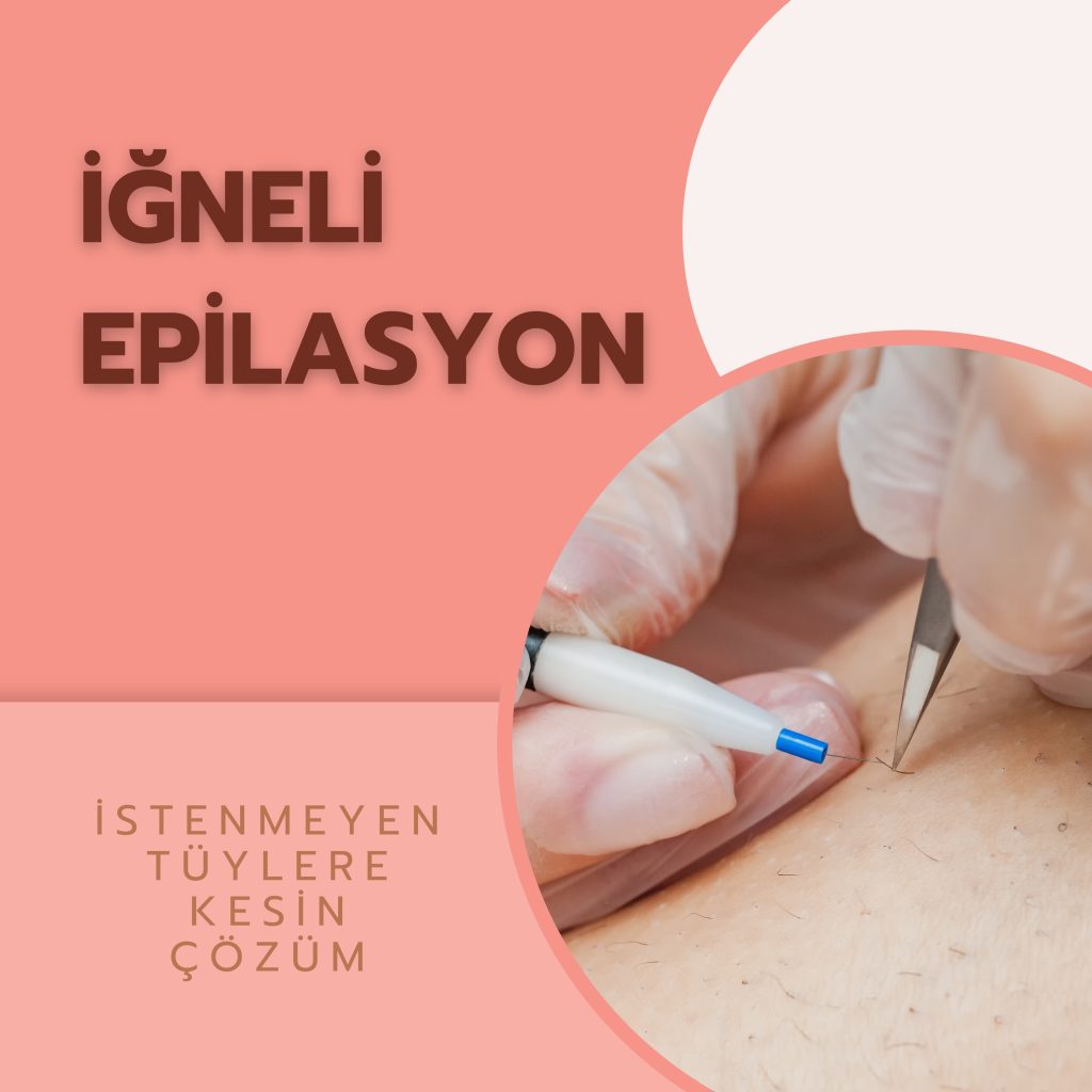 İğneli epilasyon uygulaması ve İstenmeyen Tüllere Kesin Çözüm yazısı.